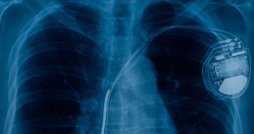 Prevenzione, diagnosi e trattamento delle infezioni dei CIEDs: il documento AIAC