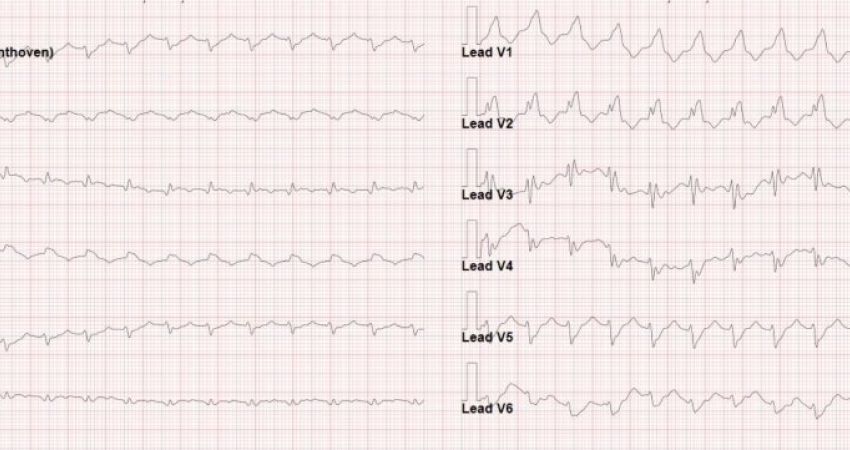 La diagnosi differenziale delle tachicardie a QRS largo
