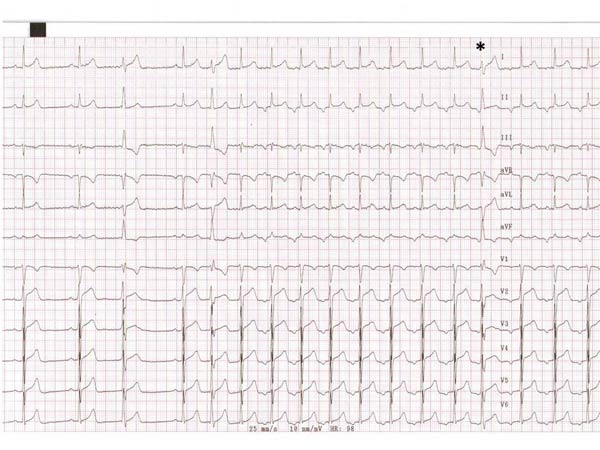 ecg forum: immagine tracciato