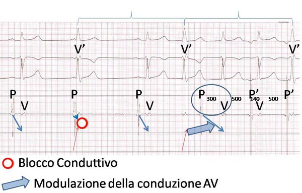 ecg forum: dettaglio tracciato