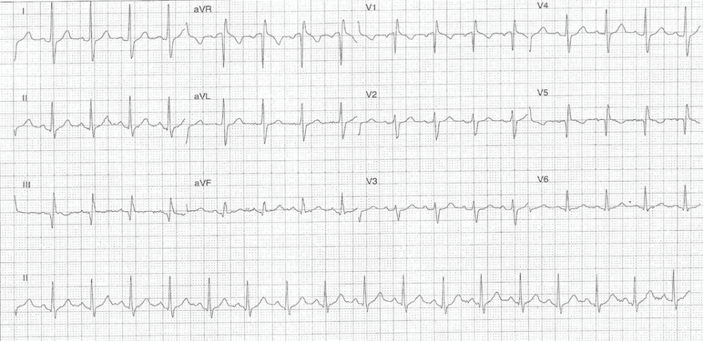 COVID-19 ECG