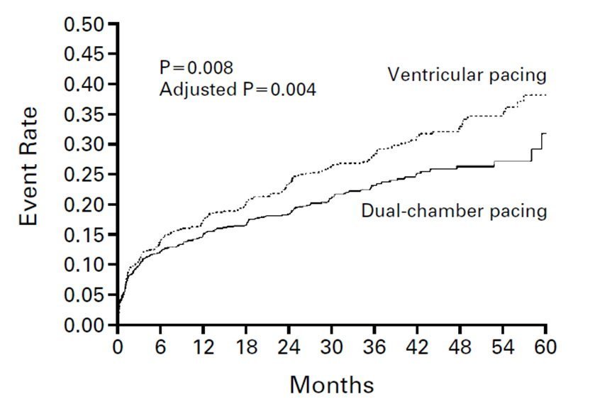 Pacemaker bicamerale